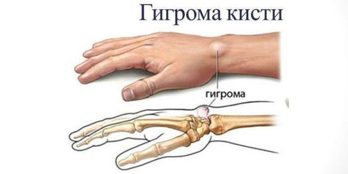 Гігрома на руці, пальці чи нозі - як лікувати в домашніх умовах та операцією