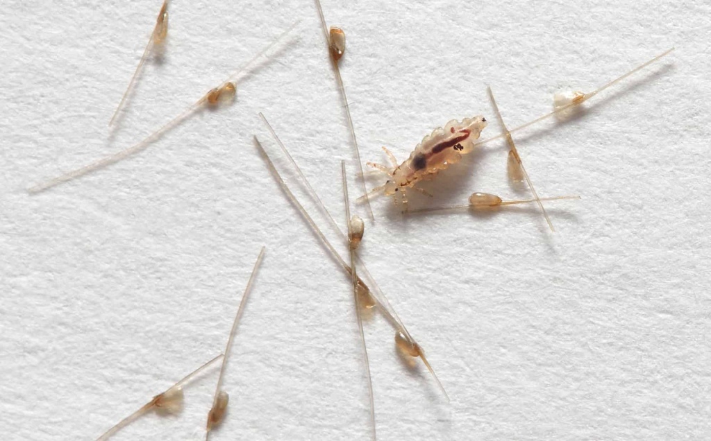 Гниди у волоссі