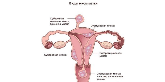 Лікування міоми матки народними засобами без операції