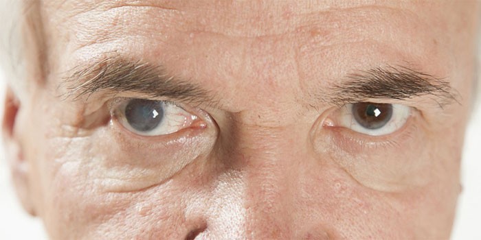 Причини більма на оці в людини - вроджені та придбані з описом та фото
