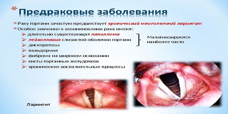Рак горла - симптоми та лікування