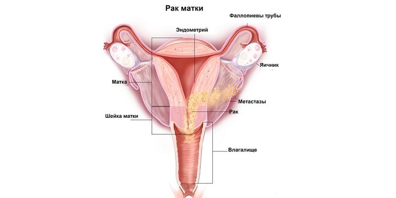 Рак матки – симптоми у жінок