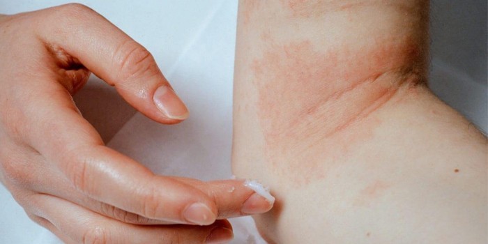 Симптоми та види мікозів шкіри людини