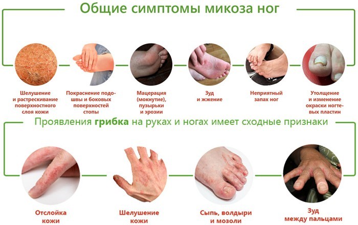 Симптоми та види мікозів шкіри людини