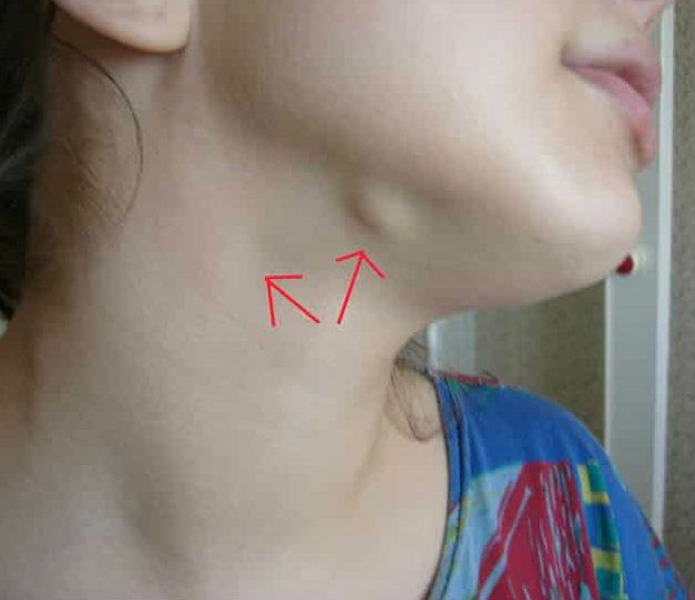 Болить лімфовузол на шиї під щелепою (праворуч або ліворуч) при натисканні, причини