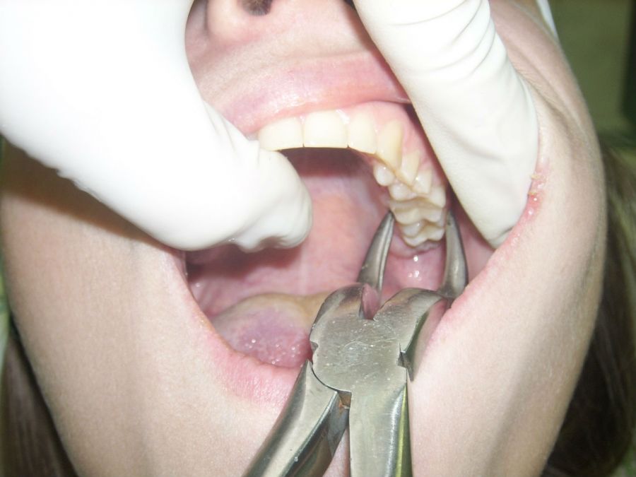 Чи боляче видаляти зуб: які болючіше виривати, видалення з уколом