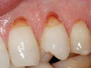 Гіперестезія зубів (твердих тканин): лікування, причини, симптоми
