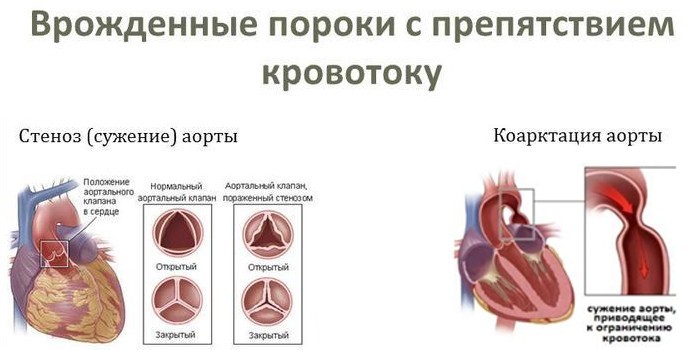 Порок серця - причини розвитку, класифікація, терапія та профілактика
