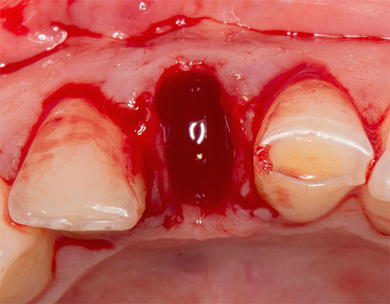 Запах із лунки після видалення зуба, причини неприємного присмаку в роті