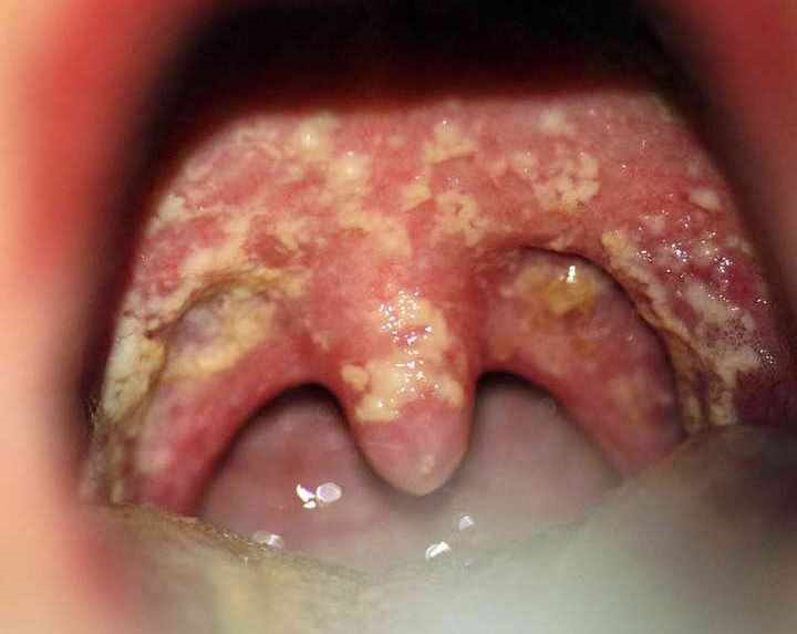 Жовте піднебіння у роті: причини такого кольору у дорослих, лікування