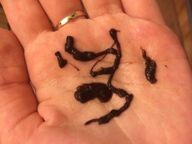 Коричневі виділення замість місячних