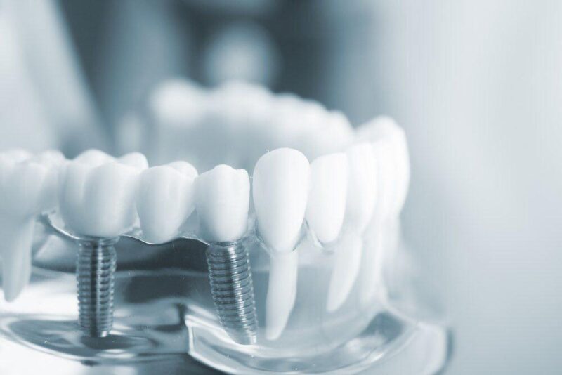Імплантація зубів у Києві