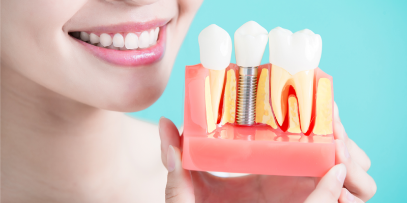 Імплантація зубів