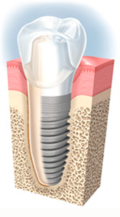 КЕС: провідна клініка з імплантації