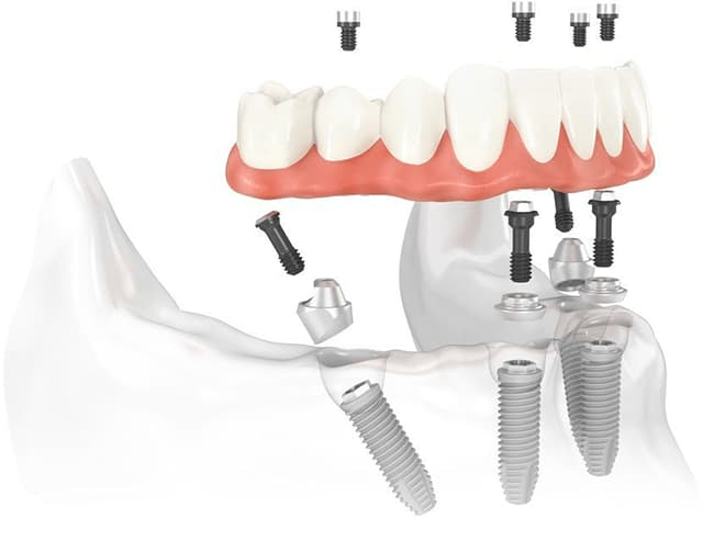 КЕС: провідна клініка з імплантації