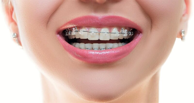 Встановлення брекетів