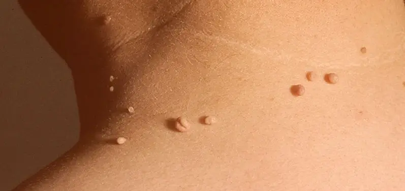 Що таке папіломи